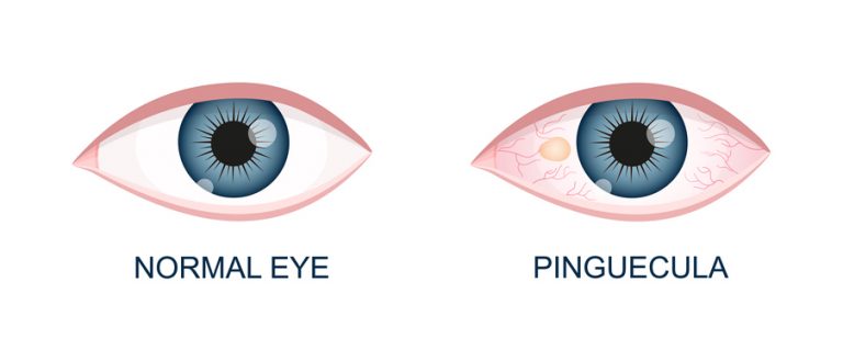 Understanding Pinguecula and Its Elimination thumbnail