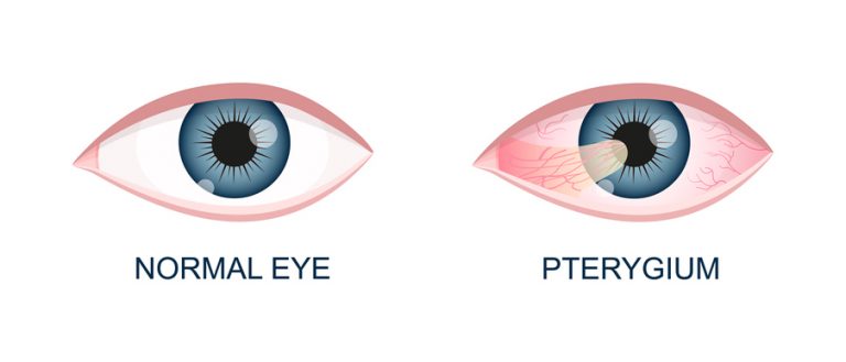 Recognizing Pterygium and Its Removal thumbnail